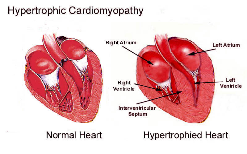 Hypertrophic_Cardiomyopathy_Dia.jpg (73218 bytes)